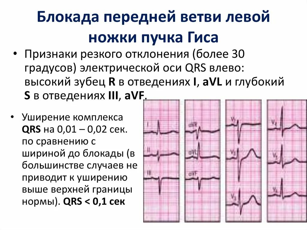 Что значит блокада левой ножки пучка гиса. Отклонение ЭОС влево, блокада передней ветви левой ножки пучка Гиса;. Блокада передней ветви ЛНПГ на ЭКГ. Блокада ветвей левой ножки пучка Гиса на ЭКГ. I44.4 — блокада передней ветви левой ножки пучка.