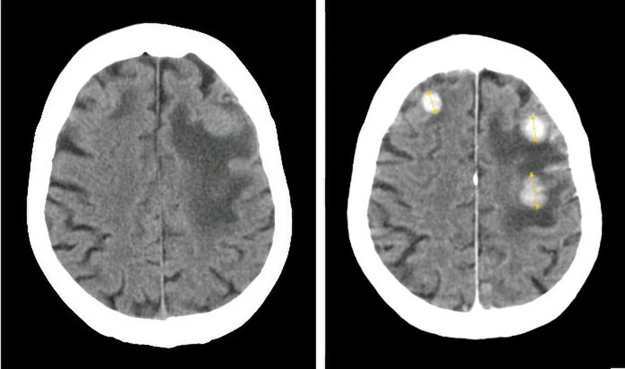 Меланома метастазы в мозг. Метастазы головного мозга кт. Опухоли и метастазы головного мозга на кт. Гиперденсные метастазы в головной мозг на кт.