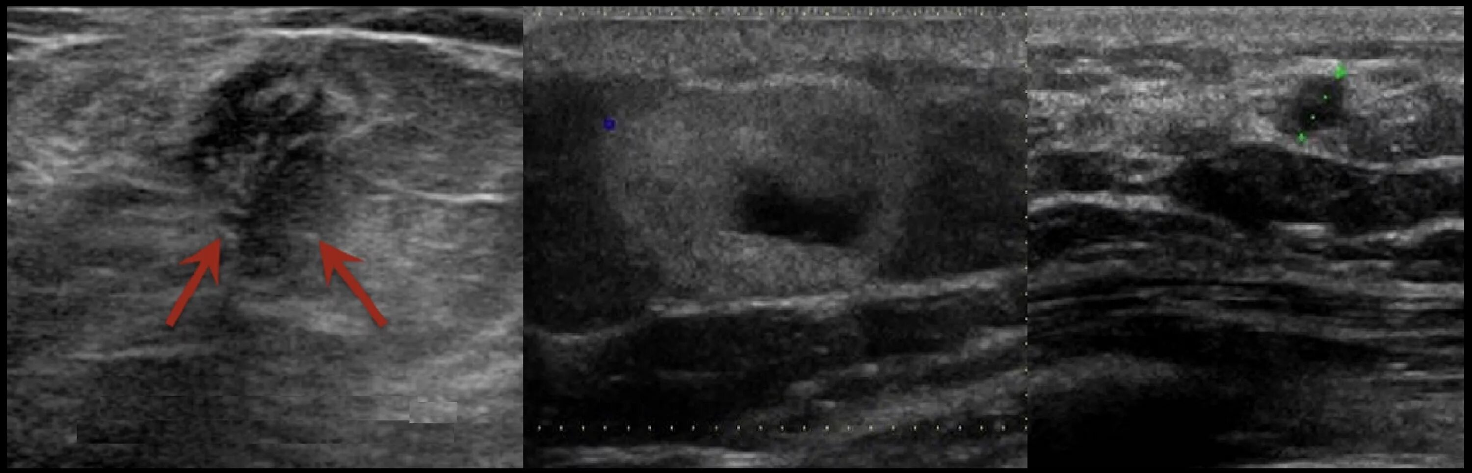 После операции опухоли молочной железы. Гранулема послеоперационного рубца на УЗИ. Осумкованная гематома на УЗИ. Гранулёма послеоперационного рубца УЗИ картина. Гематома молочной железы УЗИ картина.