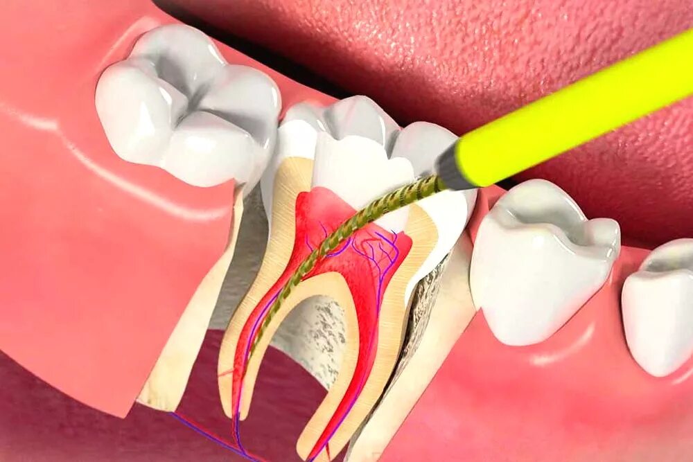 После лечения что бывает. Пульпит 2 канального зуба. Пульпита (депульпирование зуба.
