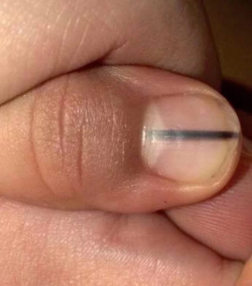 Пятно на ногте указательного пальца. Продольная меланонихия. подногтевая продольная меланонихия. онихорексис, ониходистрофия.
