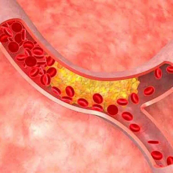Болезни кровеносного сосуда. Кровяные бляшки в сосудах. Что такое холестериновых бляшек и закупорки сосудов.