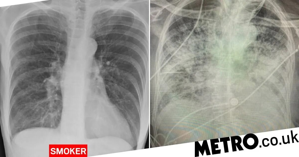 Кардиогенный отек легких у кошек. Снимок легких после коронавируса. Поражение легких при ковид19. Последствия ковида легкие. Снимок грудной клетки с пневмонией.
