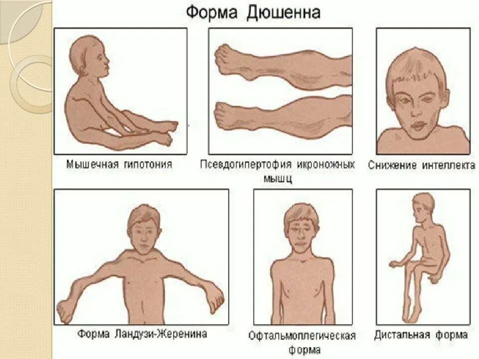 Клиническая миопатия. Мышечная дистрофия Дюшенна лекарство. Мышечная дистрофия Дюшенна клинические проявления.