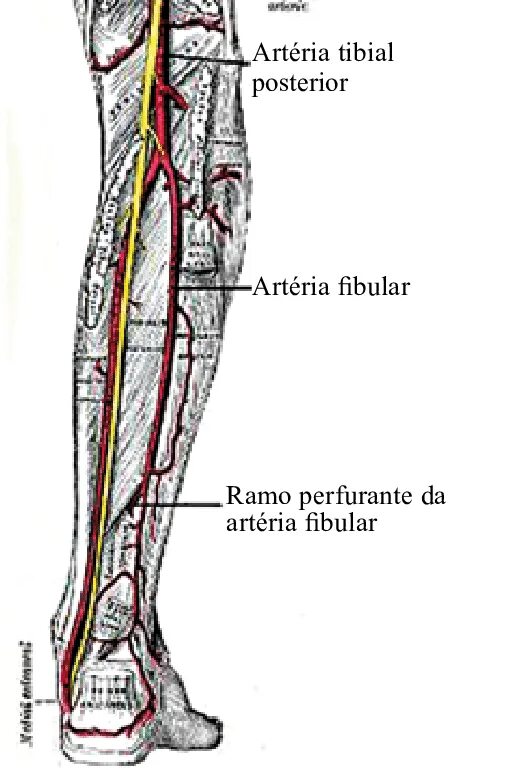 Curved tibia fibula