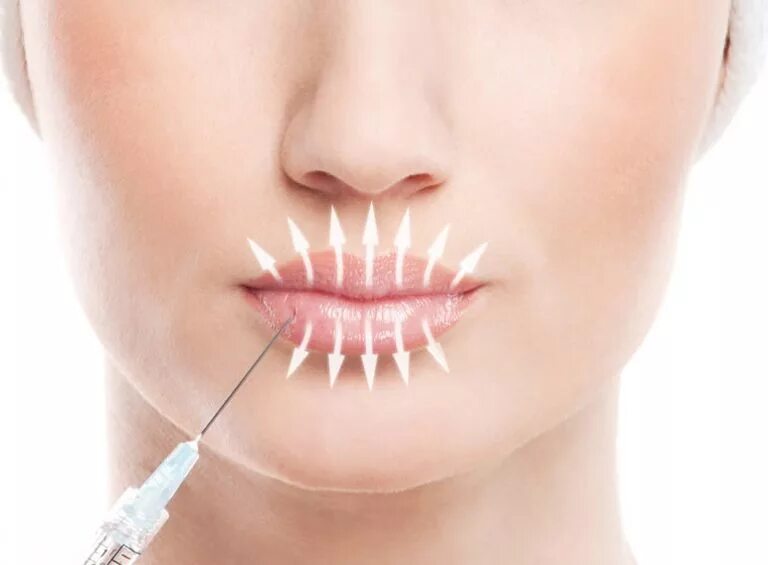 Контурная пластика. Уколы гиалуроновой кислоты в губы. Методика введения филлера в губы.