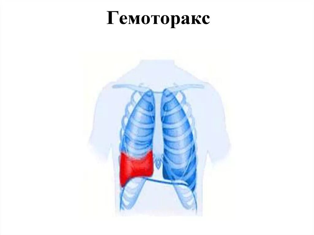 Плевральные синусы гемоторакс. Повреждение грудной клетки гемоторакс. Гимноторакс. Правосторонний гемоторакс. Наличие крови в плевральной полости