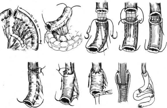 Инвагинационный ана томоз. Пищеводно тонкокишечный анастомоз. Пищеводно кишечный анастомоз по Гиляровичу.