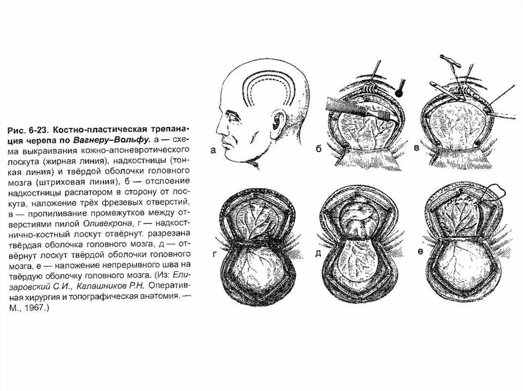 Костнопластическая Трепанация черепа по Вагнеру-Вольфу. Костный лоскут Трепанация черепа. Костно-пластическая Трепанация по Вагнеру-Вольфу. Костно пластическая Трепанация черепа по Вагнеру Вольфу и Оливекрону.