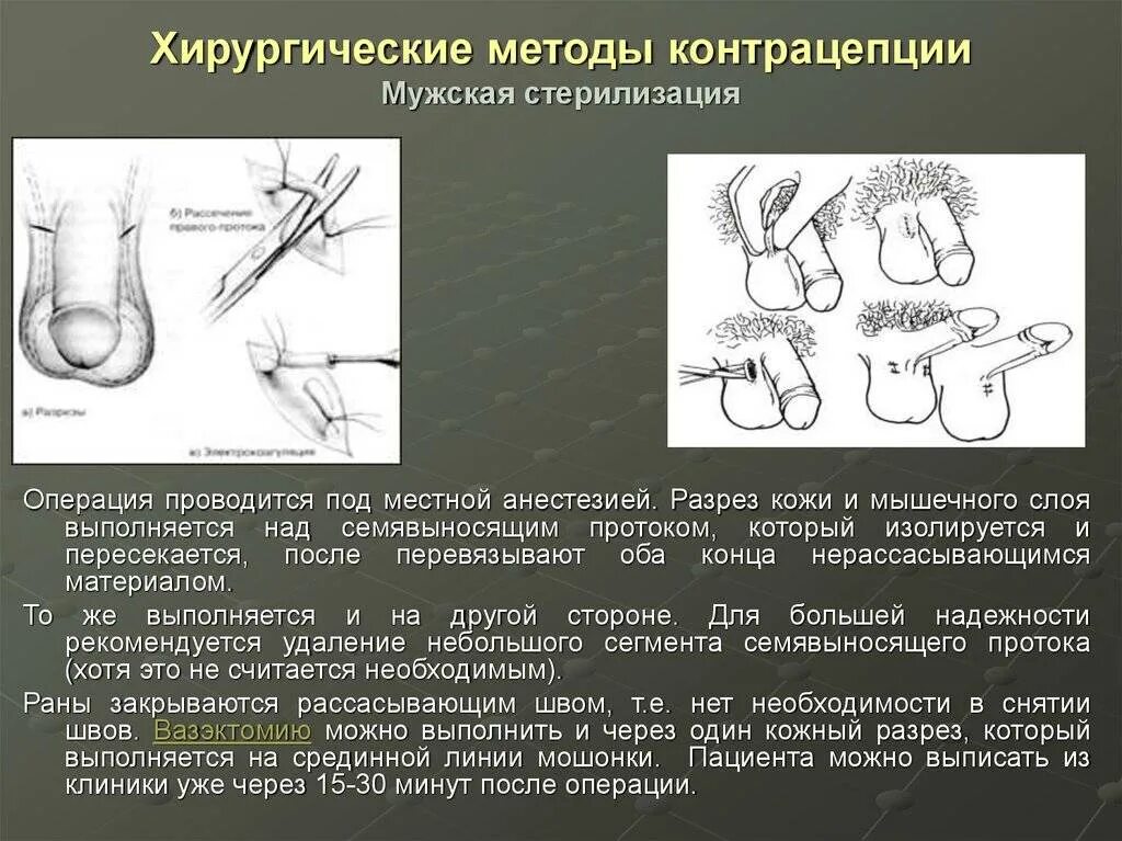 Методы контрацепции схема. Операция по стерилизации перевязка маточных труб. Хирургическая стерилизация метод контрацепции. Хирургический метод контрацептива показания. Перевязываем мужчин