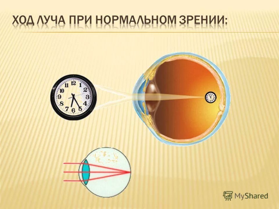 близорукость сообщение. человек с нормальным зрением рассматривает. аккомодация презентация. близорукость и дальнозоркость дети. человек с нормальным зрением рассматривает.