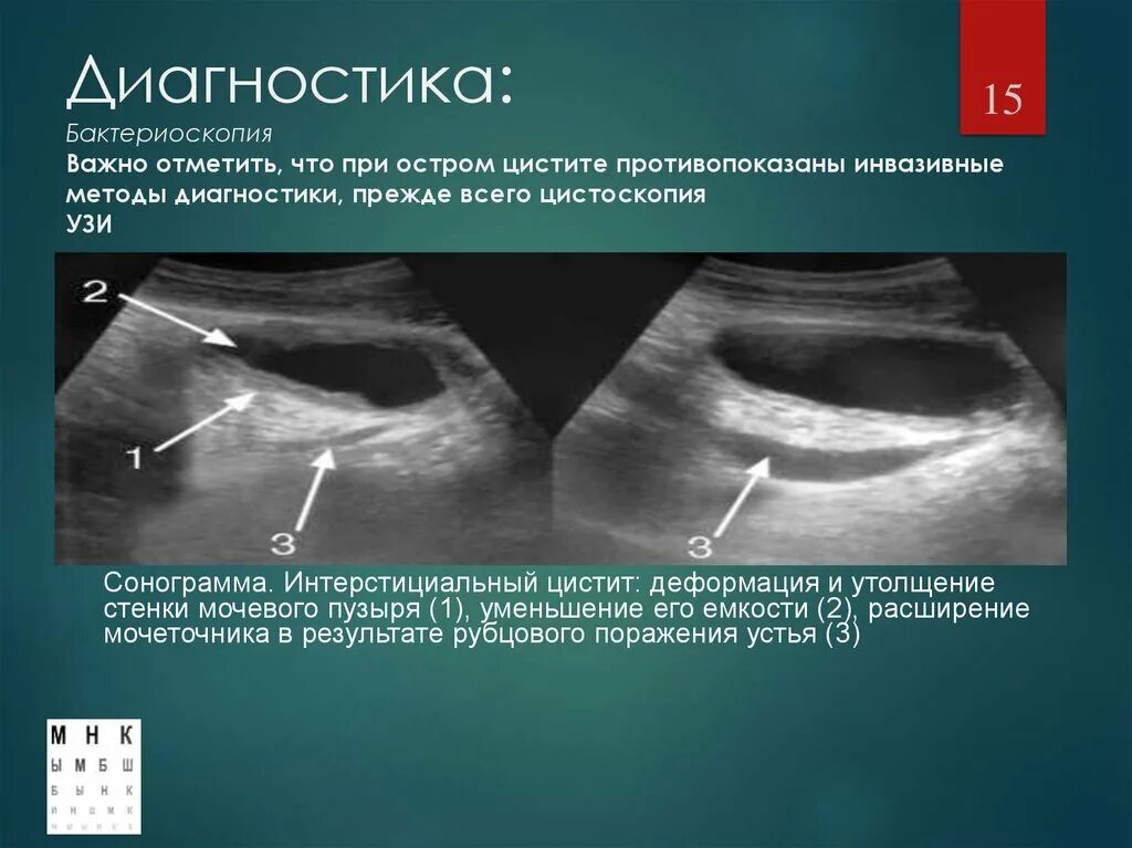 Цистит на УЗИ мочевого пузыря. Деформация мочевого пузыря на УЗИ.