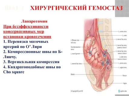 Лапаротомия ревизия гемостаз