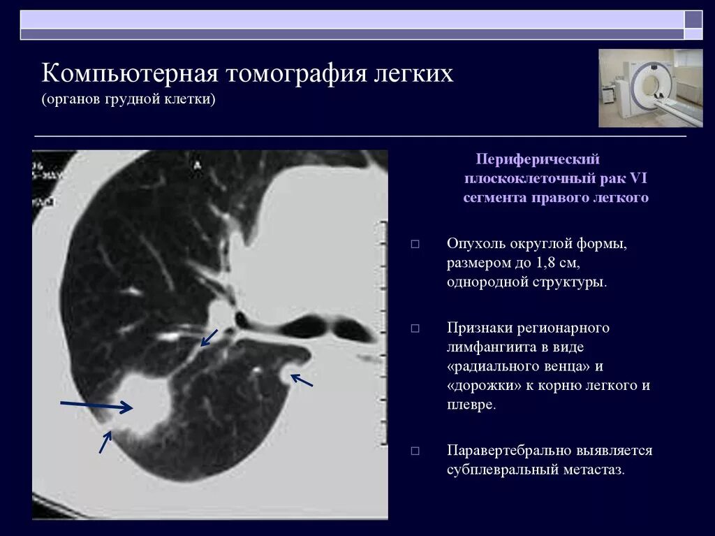 Признаки периферического легкого. Периферическая карцинома легких кт. Кт легких.