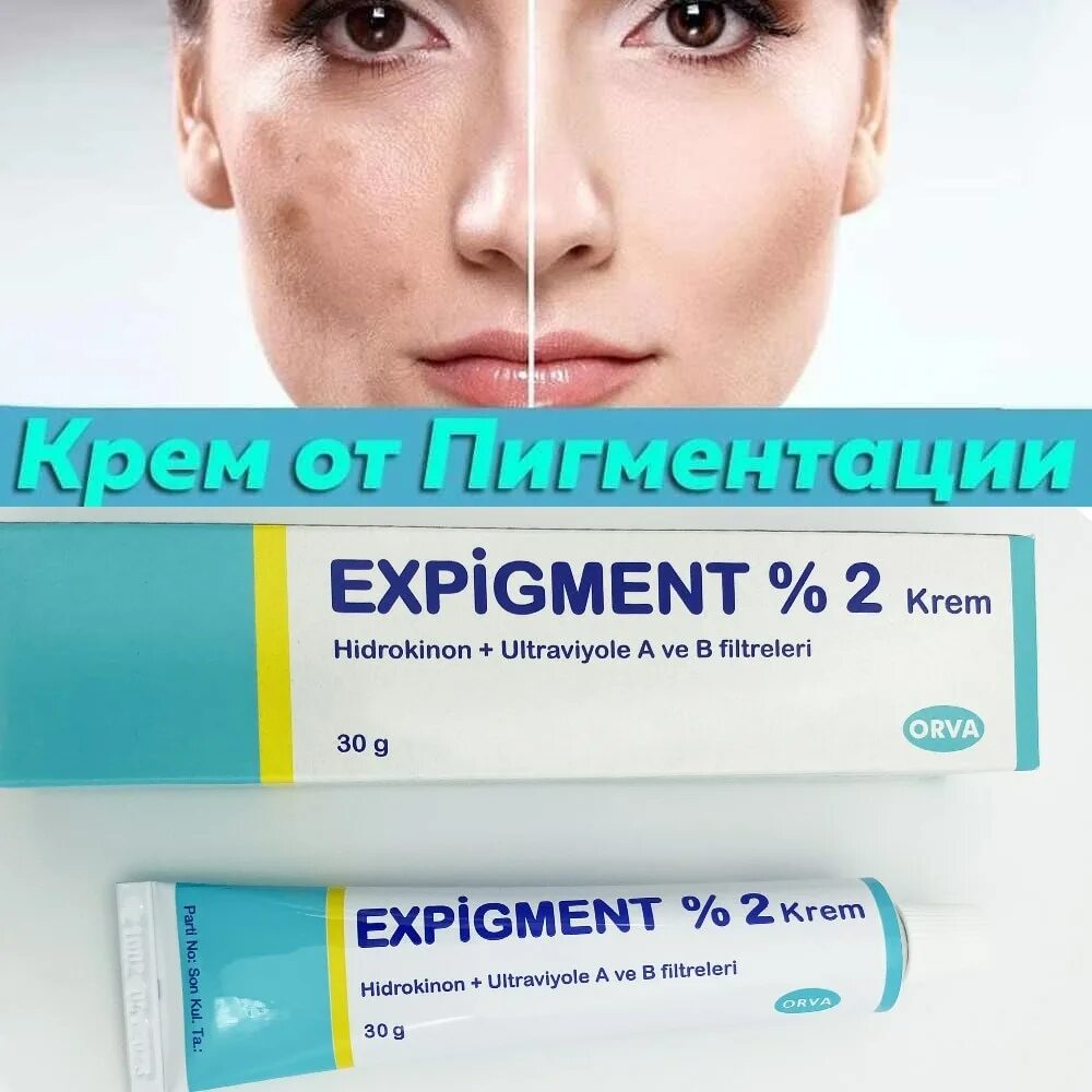Лучший крем от пигментации. Турецкий отбеливающий крем expigment. отбеливающий крем expigment 4. expigment крем 2%. orva крем отбеливающий expigment.