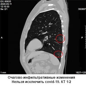 Через сколько делать кт