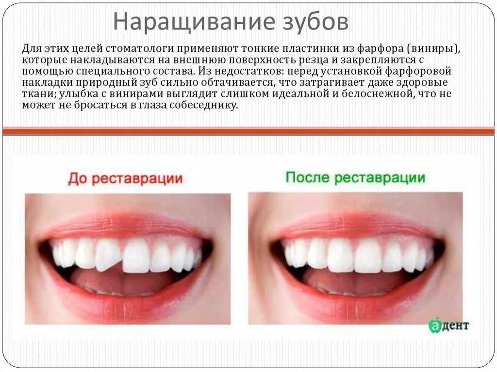 Сколько по времени делают зубы. Наращивание передних зубов. Наращивание зуба полимером.