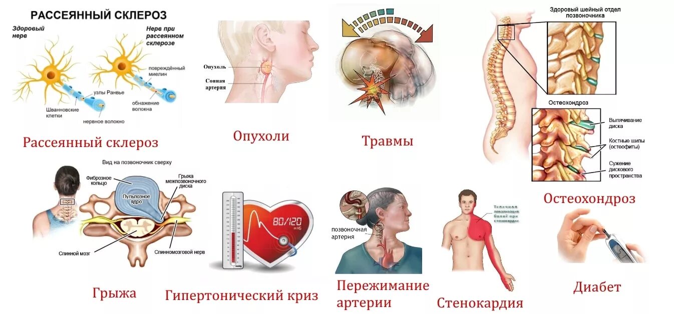 Немеет голова причины. Немеет голова причины у мужчин. Немеет голова причины у мужчин. Головная боль в висках причины. Шейный остеохондроз лечение.