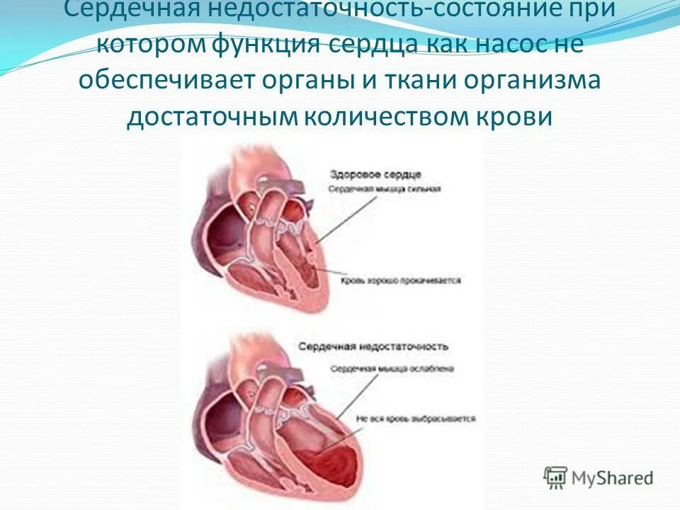 Сердечная недостаточность. Сердечный недостаточность. Сердечнаяснедостаточность. Хроническая недостаточность сердца. Застойная сердечная недостаточность смерть