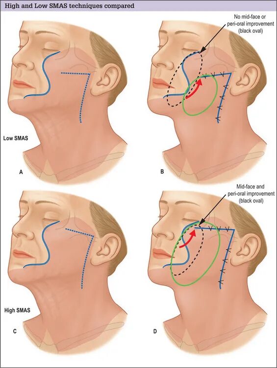 Операция смас лифтинг лица и шеи. Операция smas-лифтинг схема. Смас нижней трети лица и шеи. Схема подтяжки лица