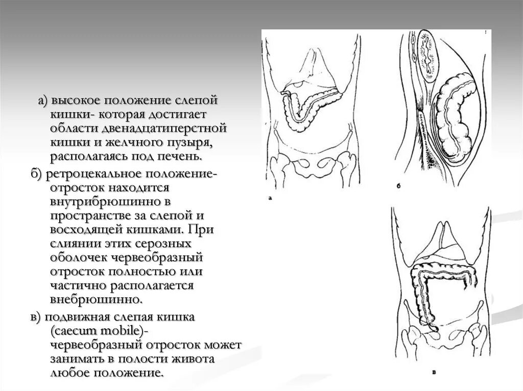 Высокое расположение слепой кишки. Положение червеобразного отростка в брюшной полости. Червеобразный отросток слепой кишки. Высокое расположение купола слепой кишки. Включает в себя слепую кишку