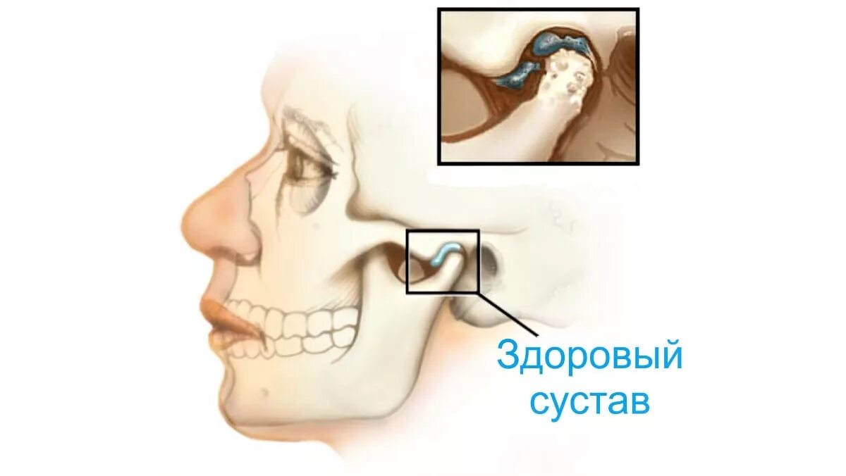 Заболевание нижней челюсти. Артрит височно-нижнечелюстного сустава симптомы.