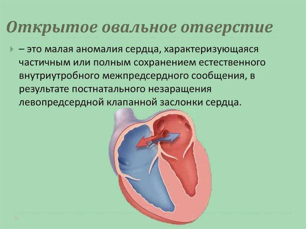 Овальный клапан. Открытое овальное отверстие в сердце у ребенка. Овальный клапан. Открытое овальное окошко у новорожденного. Овальный клапан.