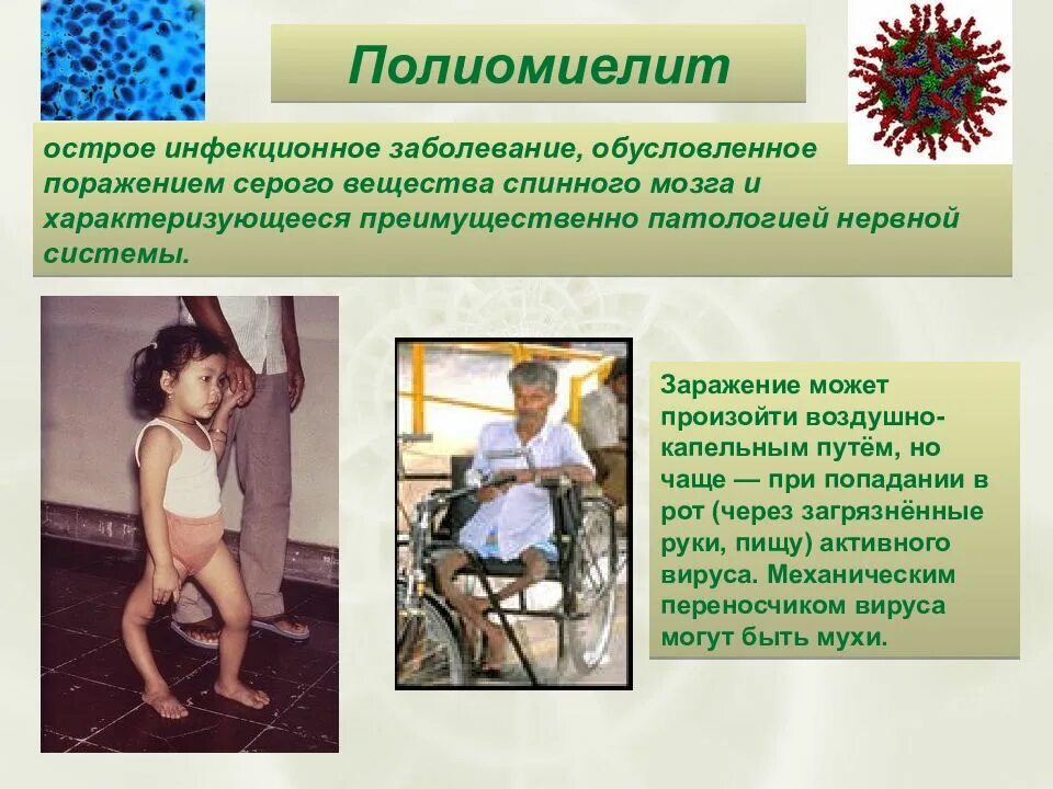 Полиэмилит что за болезнь. Полиомиелит (детский паралич). Бульбарная форма полиомиелита. Полиомиелит входные ворота инфекции. Вирусные заболевания полиомиелит.