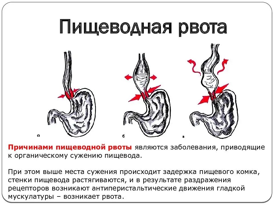 Портит ли рвота пост. Пищеводная рвота. Причины рвоты. Тошнота и рвота причины. Как происходит тошнота.