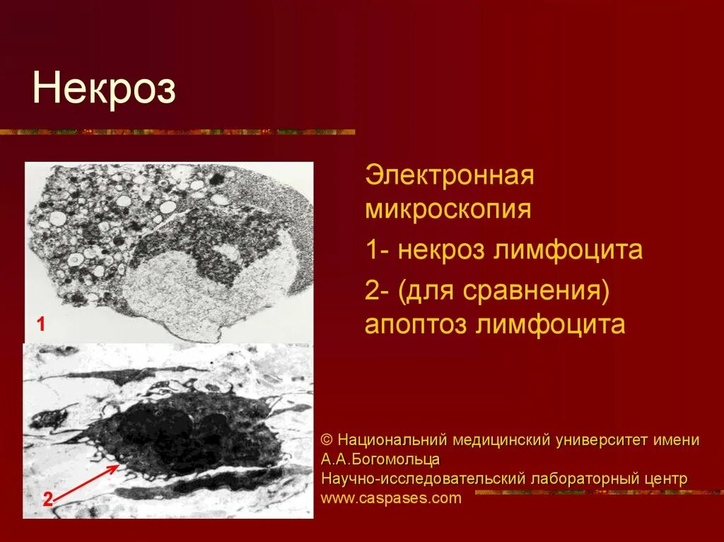 Некроз прогнозы. Электронная микроскопия некроз. апоптоз микроскопия.