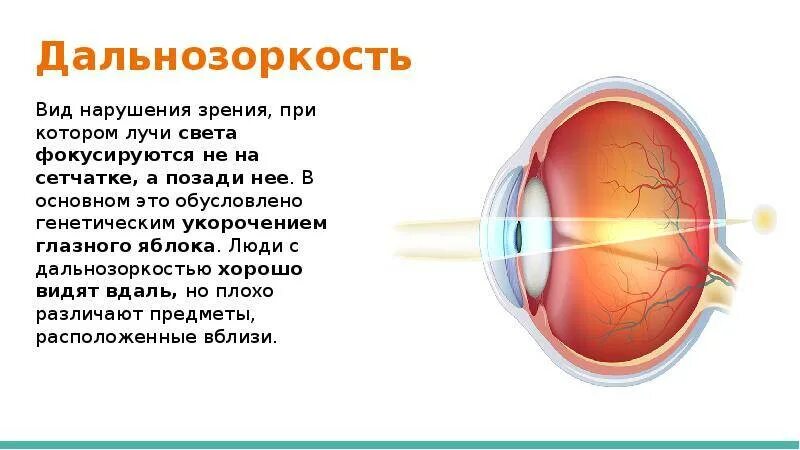 Сообщение на тему дальнозоркость. Дальнозоркость. зрение дальнозоркость. дальнозоркость глазное яблоко. дальнозоркость кратко.