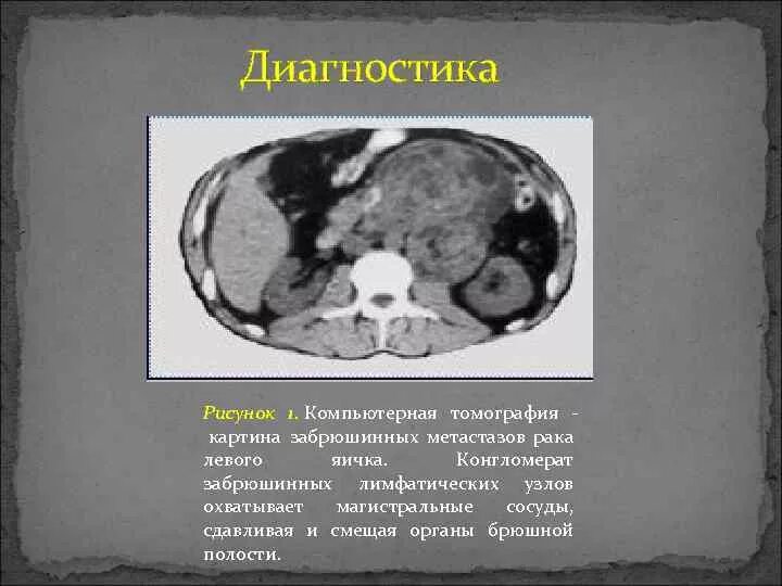 Метастазы в яичках