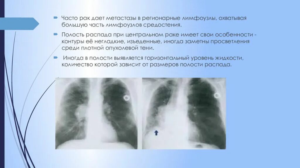 Узлы в легких что это. Метастазы в лимфоузлы средостения. Полостные образования в легких. Метастатические опухоли лимфатического узла.