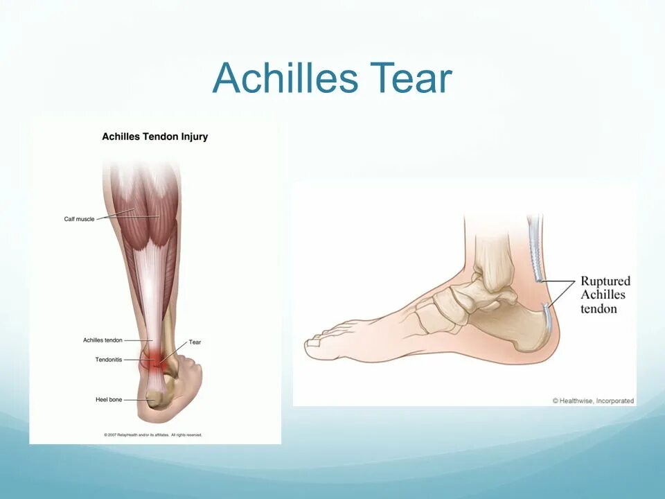 Где находится ахиллесова пята. Ахиллесова пята фото. Ахиллесова пята сухожилие. Ахиллесова пята фото. Ахиллесова пята.
