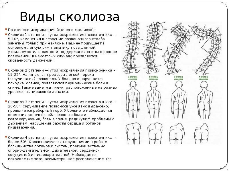 S образный сколиоз 1 степени по чаклину. Сколиоз позвоночника 1 стадия. Сколиоз позвоночника 5 степени.