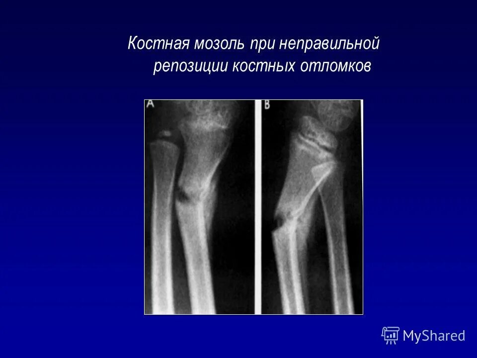 механизм образования костной мозоли. периостальная мозоль. параоссальная костная мозоль. типы костной мозоли. периостальная мозоль.