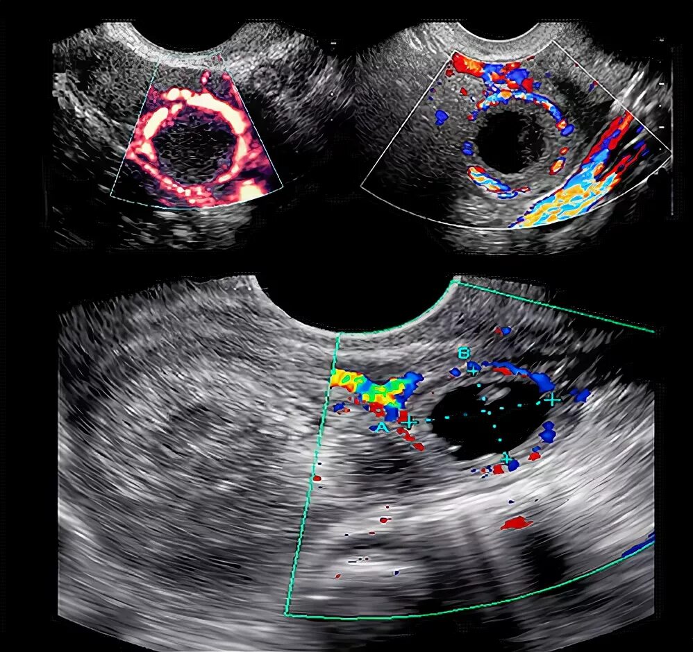Персистенция фолликула на УЗИ. Лютеинизированный фолликул на УЗИ. Можно перепутать беременность с кистой