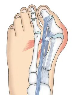 Hallux valgus что это такое