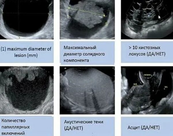 Киста яичника orads. Классификация опухолей яичников УЗИ. Образование яичника классификация. O-rads УЗИ. Классификация кист яичника на УЗИ.