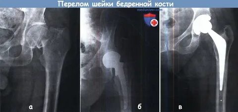 Операция на шейке бедра прогноз
