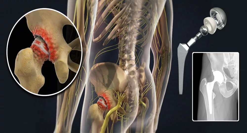 Операция по замене тазобедренного как происходит. Коксартроз эндопротезирование тазобедренного сустава. Ревизионное эндопротезирование тазобедренного сустава. Операция эндопротез тазобедренный. Коксартроз операция эндопротезирование.