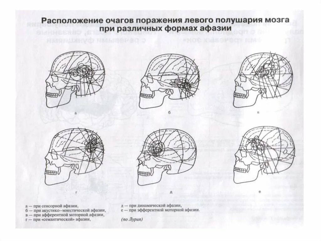 Поражение левого полушария мозга. Динамическая афазия локализация очага поражения. Локализация поражений мозга при афазии. Схема локализации разных форм афазии. Очаг поражения при моторной афазии.