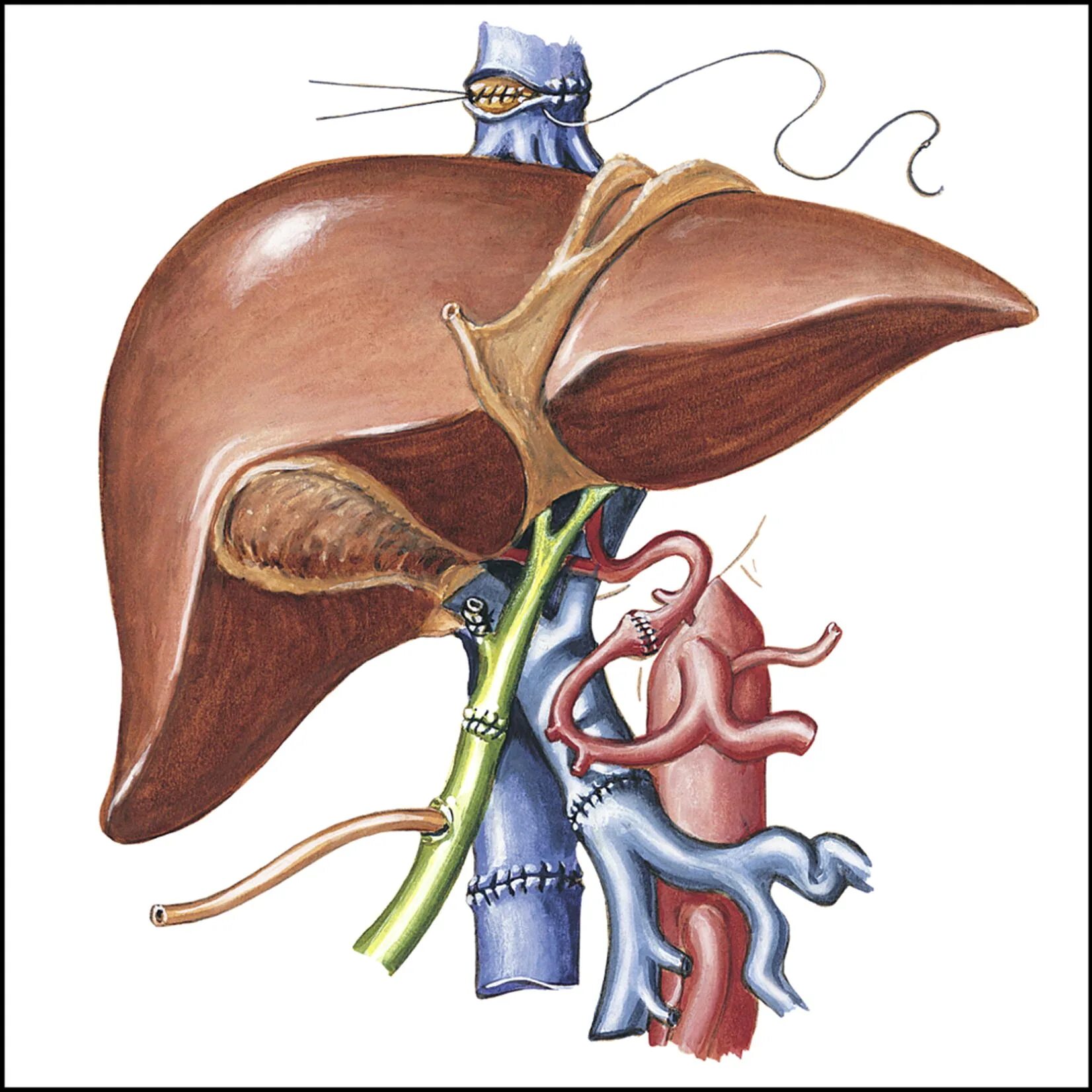 Печень после операции. Ортотопическая трансплантация печени. Трансплантация печени анастомоз. Аутотрансплантация печени.