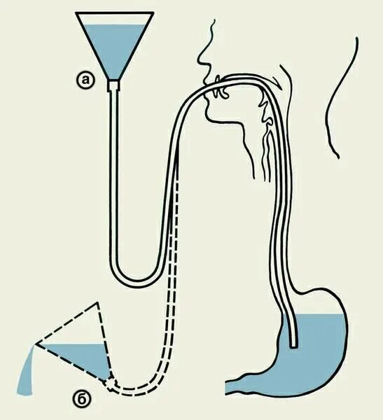 Сифонные промывания кишечника показания. Водно сифонная проба что это. Водно сифонная проба что это. Водно сифонная проба что это. Сифонная клизма показания.