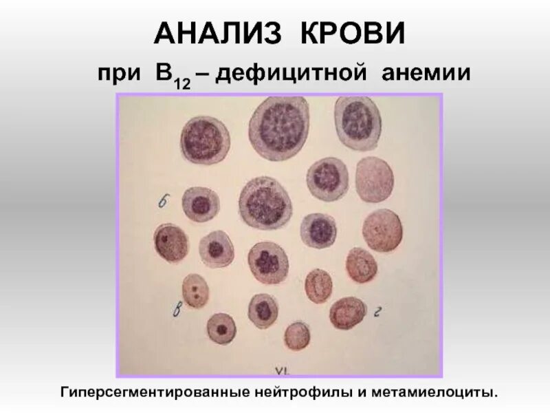Метамиелоциты. Пойкилоцитоз при в12 дефицитной анемии. нейтрофилы метамиелоциты. промиелоциты в крови.