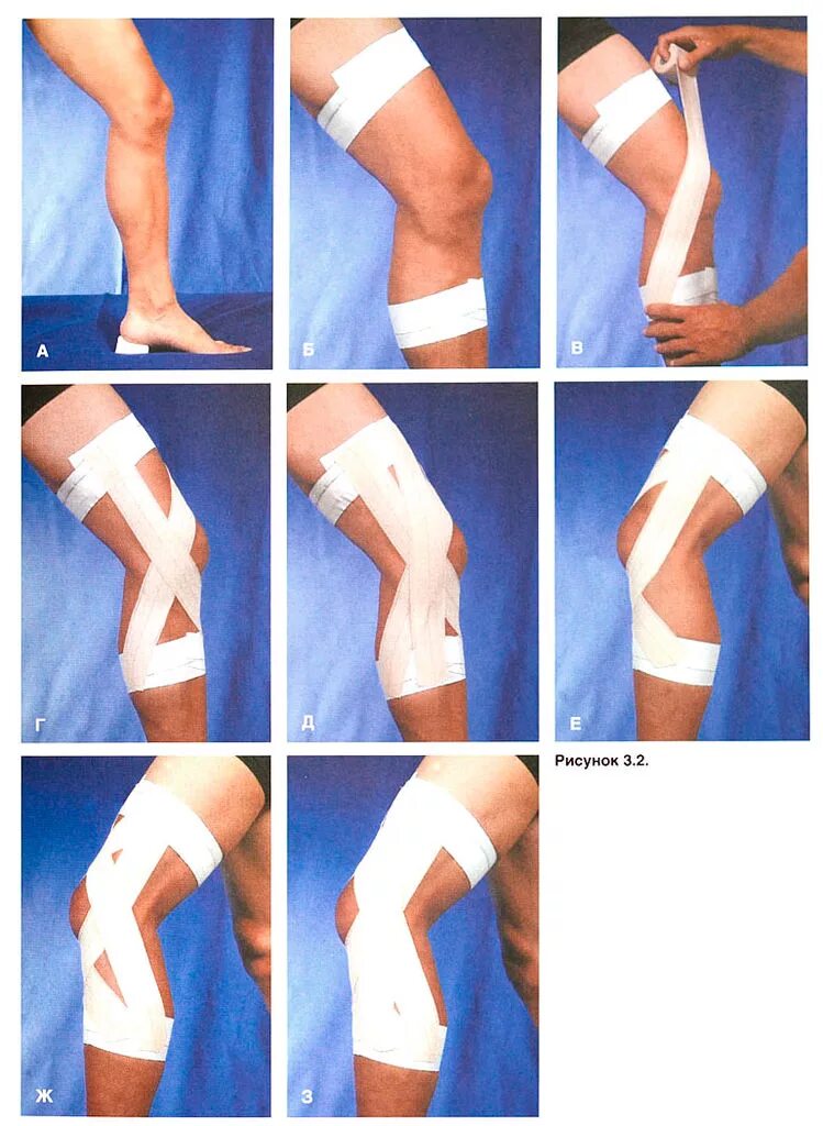 Как перевязывать колено. Тейпирование связок коленного сустава. Перевязка коленного сустава эластичным бинтом. Тейпирование коленного сустава мениск. Тейпирование Шляттера.