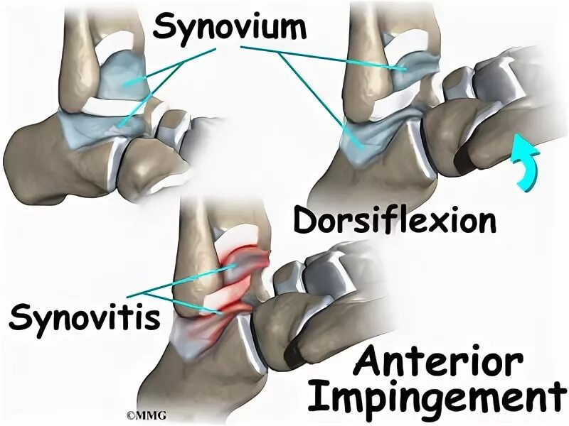Импинджмент синдром голеностопного сустава рентген. Импиджмент синдром голеностопного сустава. Задний импинджмент синдром голеностопного. Импиджмент синдром голеностопного сустава мрт.
