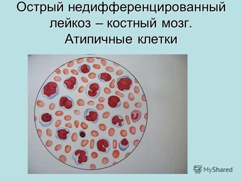 миелоцитарный лейкоз гистология. острый лейкоз миелограмма. осложнения острого лейкоза. острый лейкоз костного мозга. острый лейкоз картина крови.