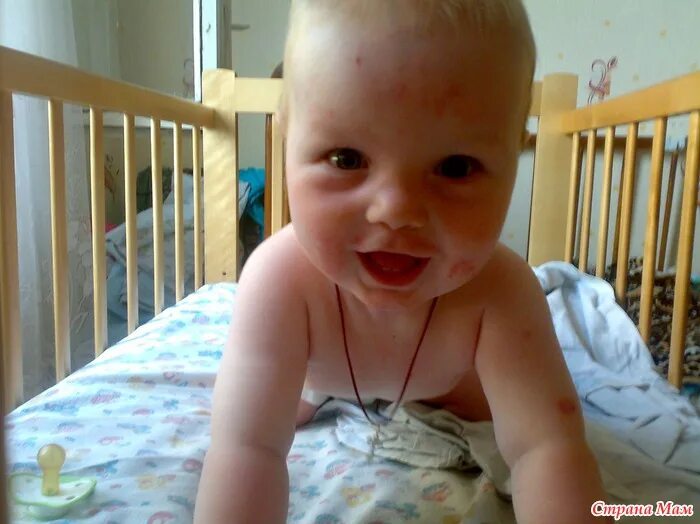 аллергия у ребенка на прикорм. может ли быть на прикорм аллергия. может ли быть на прикорм аллергия. аллергия на бейби калм.