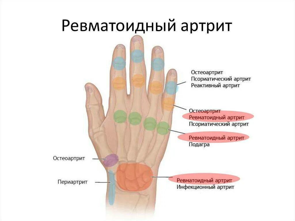 Почему болит мизинец на руке. Псориатический артрит симптомы. Ревматоидный псориатический артрит. Определяющие симптомы ревматоидного артрита. Псориатический артрит схема.